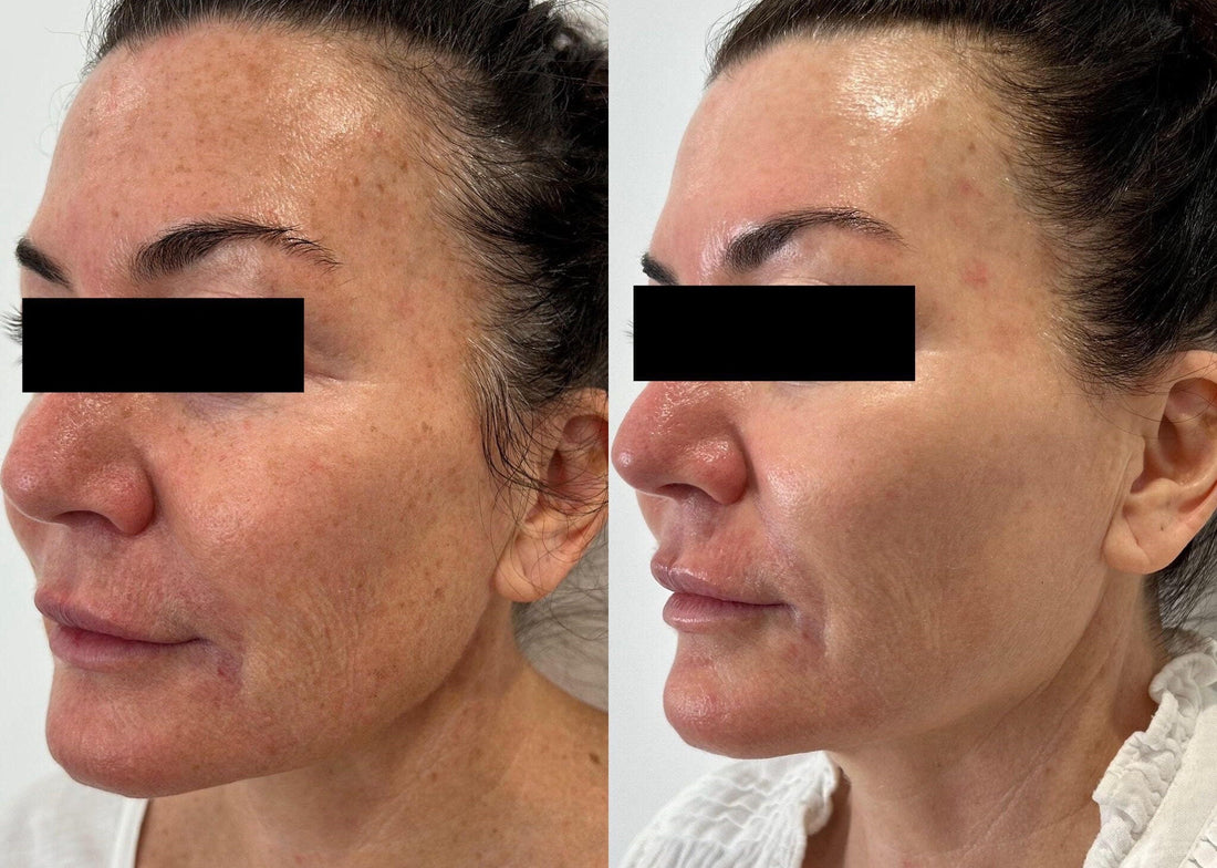 Lumecca IPL treatment at Aqua